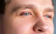 Bacteria Staphylococcus y el estrés detrás del molesto bulto ocular – Correo del Caroní