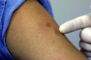 En Santa Cruz confirman dos casos de viruela símica y cuatro sospechosos y el Sedes intensifica vigilancia epidemiológica
