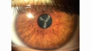 Catarata: volver a ver con claridad