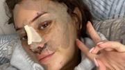 ¿Un lifting a los 28? Por qué cada vez hay más jóvenes que recurren a la cirugía plástica
