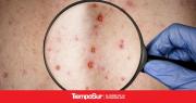 Alerta por dos casos confirmados de la Viruela del Mono en Calafate y Gregores