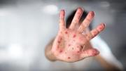 Red de Salud de Uncía se pone en alerta ante posibles contagios de sarampión