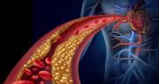 Colesterol alto: señales de alerta, causas más comunes y cómo prevenir complicaciones