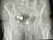 Fue al hospital por un fuerte dolor de panza y los médicos descubrieron un reloj, tuercas y tornillos en su cuerpo