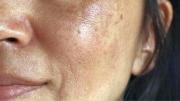 ¿Cómo utilzar el aceite de oliva para quitar las manchas de la cara?