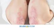 Más del 20% de las personas con psoriasis en Argentina presenta formas severas de la enfermedad