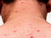 El país de América que perdió el estatus de libre de sarampión y cómo afecta a la Argentina y al resto de la región