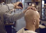 Cuidar la calva tiene su precio: conozca los tratamientos y precios