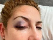 Ese ojo morado existió: Fabiola Yañez dio detalles de uno de los hechos de violencia por los que denunció a Alberto Fernández