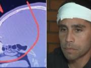 Habló el jugador del Ascenso que le clavaron una llave en la cabeza: No sabían si podían salvarme, por suerte lo puedo contar