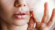 Herpes labial: expertos revelaron los desencadenantes y las claves para controlar los brotes