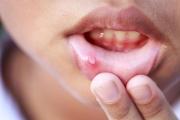 Salud Bienestar /Herpes labial: ¿Qué lo activa y como controlar los brotes?