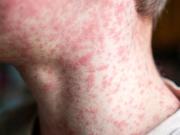 Sarampión: confirman cuatro casos importados y activan vigilancia en varias provincias