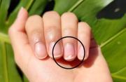 Manchas blancas en las uñas: qué significan realmente y por qué aparecen