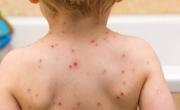 Un brote de sarampión enciende alarmas en la Provincia: los síntomas y cómo se contagia