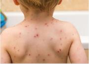 Alerta en Salta: familias extranjeras contagiadas de sarampión, sin vacunación, pasearon por el país