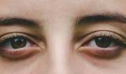 Adiós ojeras: trucos caseros para reducir su impacto en el rosto