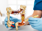 ¿Cáncer colorrectal a los 40? Sí