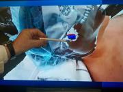 La cirugía del futuro ya se hace en un hospital público de Coghlan: cómo se opera con realidad aumentada