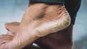 Cómo limpiar y reparar los talones negros y agrietados por andar descalzo