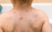 Alerta por sarampión: la familia que cruzó medio país tuvo al menos 98 contactos estrechos
