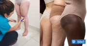 Qué es el lipedema, la enfermedad crónica que se confunde con obesidad y sobrepeso ¿Cómo se trata?