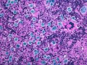 Médicos israelíes lograron un avance impensado en el tratamiento de un tipo de cáncer