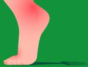 ¿Qué es la gota y por qué va en aumento?