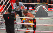 La impactante imagen de la DOBLE FRACTURA que sufrió Jake Paul tras derrota ante Anthony Joshua