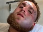 Jake Paul mostró cómo tiene la cara a cinco días del nocaut de Anthony Joshua que le destruyó la mandíbula