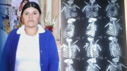Huaraz: Madre lucha por su vida por fierro incrustado cerca a su corazón