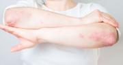 Psoriasis: una enfermedad visible, pero poco comprendida