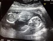 Nacieron trigemelas en Chubut: cuáles son las características de un embarazo múltiple