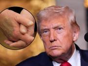 Moretones en las manos de Trump: el dato que preocupa sobre su salud