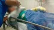Adolescente quedó con el 60% del cuerpo quemado tras la explosión de su celular