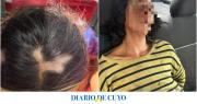 Una mujer le arrancó varios mechones de cabello a otra durante una pelea callejera