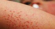 Confirman primer caso de sarampión en Atacama: ¿Cuáles son los síntomas y qué hacer si aparecen?