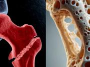 ¿Es posible una terapia eficaz y segura contra la osteoporosis?