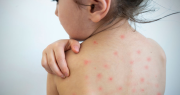 Alerta sanitaria: confirman el primer caso de sarampión del año en el país