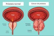 Vesículas del tejido graso de la próstata influyen en evolución del cáncer, según estudio