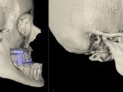 Científicos descubrieron una operación quirúrgica maxilofacial de hace 2.500 años