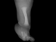 Un nene con una rara enfermedad fue operado para desarrollar un hueso fundamental