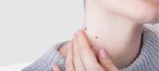 ¿Por qué salen verrugas en el cuello? Causas, contagio y cuándo preocuparse
