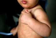 Sarampión: en América hay alerta epidemiológica, ¿cómo está Ecuador?