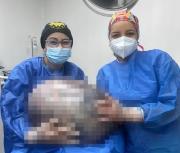 Extirpan tumor gigante de 25,5 kilogramos en el Hospital Luis Razetti de Barcelona (+Fotos)