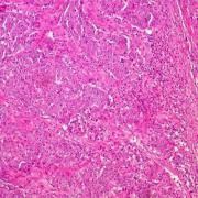 Casi la mitad de los cánceres colorrectales ahora ocurren en pacientes más jóvenes