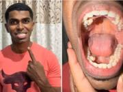 El hombre cuya boca asombra al mundo: tiene 42 dientes