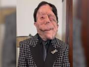 Qué es la neurofibromatosis, la enfermedad que el actor Adam Pearson visibilizó en los Premios Oscar