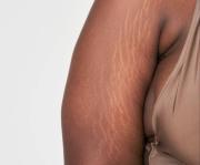 Mantén la piel firme y sin estrías: entérate de cuál es la fórmula casera milagrosa que ayuda a lograrlo