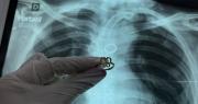 Hallan anillo en el pulmón de paciente con traqueotomía y desconocen cómo llegó allí